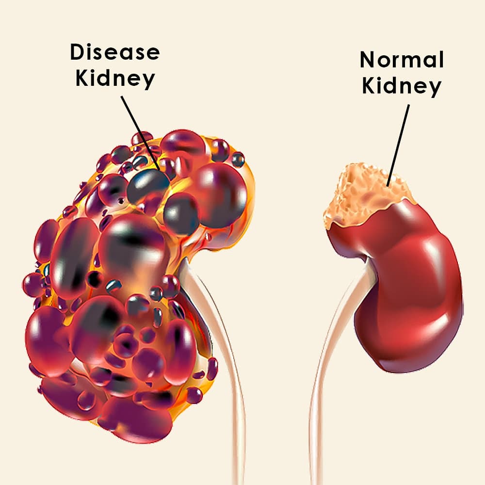 Kidney Diseases