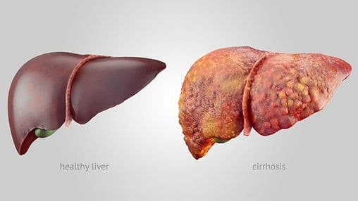 Liver Diseases